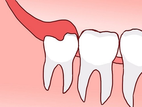 Răng khôn là răng số mấy? Ở vị trí nào trong khoang miệng 2 Răng khôn là răng số mấy? Ở vị trí nào trong khoang miệng 2