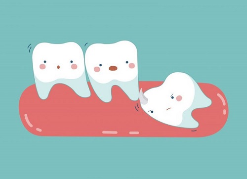Răng khôn là răng số mấy? Ở vị trí nào trong khoang miệng 3 Răng khôn là răng số mấy? Ở vị trí nào trong khoang miệng 3
