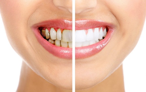 Theo bạn có nên tẩy trắng răng nhiều lần không? 1 Theo bạn có nên tẩy trắng răng nhiều lần không? 1