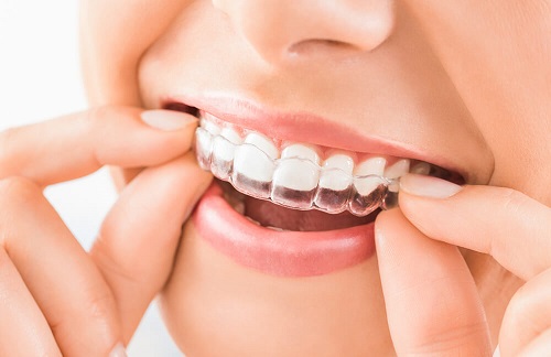 Niềng răng 1 hàm có đau không? Thông tin cần biết trước khi niềng răng 2