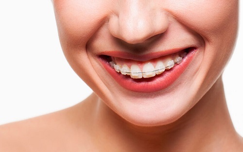 Niềng răng bị hóp má trong là do đâu gây ra? 2 Niềng răng bị hóp má trong là do đâu gây ra? 2