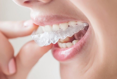 Niềng răng bị hóp má trong là do đâu gây ra? 3 Niềng răng bị hóp má trong là do đâu gây ra? 3