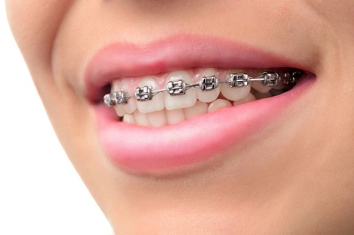 Niềng răng bị lòi chân răng - Bác sĩ nói gì về vấn đề này? 3 Niềng răng bị lòi chân răng - Bác sĩ nói gì về vấn đề này? 3