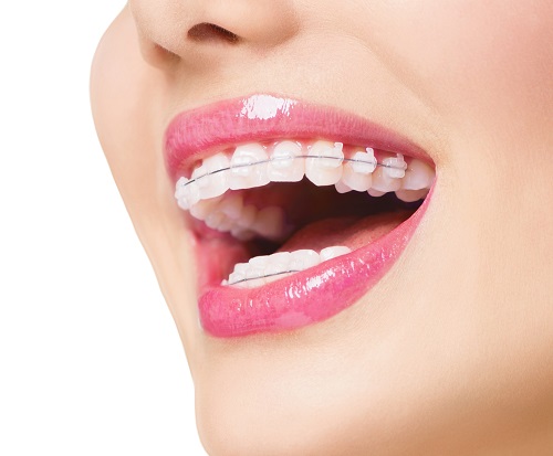 Niềng răng bị lòi chân răng - Bác sĩ nói gì về vấn đề này? 4 Niềng răng bị lòi chân răng - Bác sĩ nói gì về vấn đề này? 4