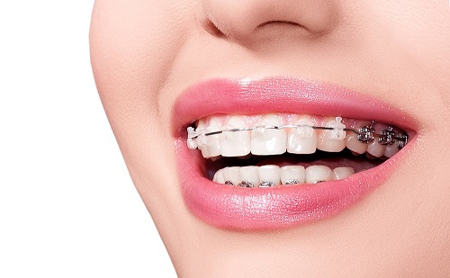 Niềng răng chữa cười hở lợi có được không? 1
