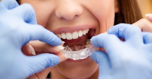 Niềng răng gây hôi miệng - Nguyên nhân thực sự do đâu 2 Niềng răng gây hôi miệng - Nguyên nhân thực sự do đâu 2
