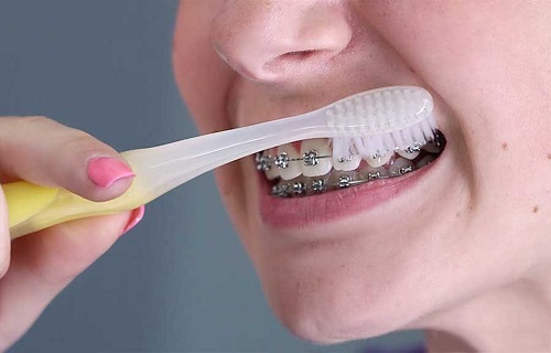 Niềng răng gây hôi miệng - Nguyên nhân thực sự do đâu 3 Niềng răng gây hôi miệng - Nguyên nhân thực sự do đâu 3
