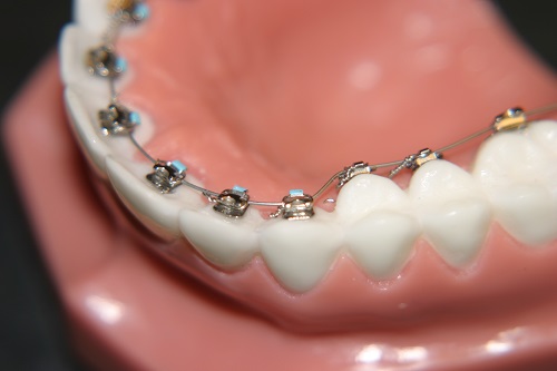 Niềng răng hàm dưới mất bao lâu là có kết quả? 1 Niềng răng hàm dưới mất bao lâu là có kết quả? 1