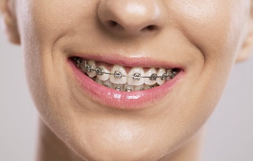 Niềng răng lệch nhân trung - Cách khắc phục cho khuôn hàm đẹp 1 Niềng răng lệch nhân trung - Cách khắc phục cho khuôn hàm đẹp 1