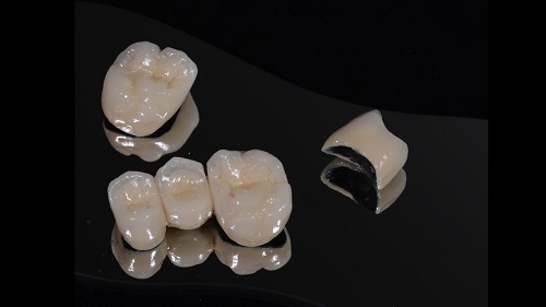 Răng sứ titan có mấy loại phổ biến nhất hiện nay 1 Răng sứ titan có mấy loại phổ biến nhất hiện nay 1
