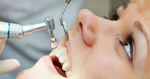 Răng sứ titan có mấy loại phổ biến nhất hiện nay 4 Răng sứ titan có mấy loại phổ biến nhất hiện nay 4