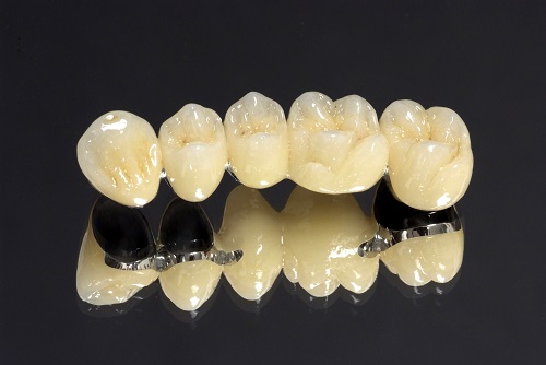 Có nên trồng răng sứ kim loại không? Vì sao 1 Có nên trồng răng sứ kim loại không? Vì sao 1