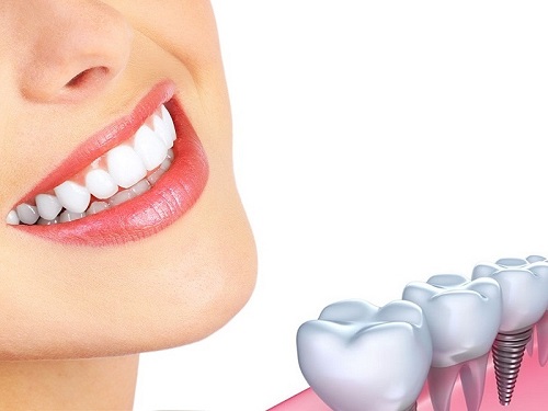 Có nên trồng răng sứ kim loại không? Vì sao 2 Có nên trồng răng sứ kim loại không? Vì sao 2