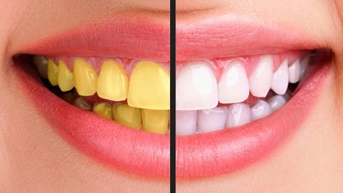 Răng sứ có bị xuống màu không? Cách khắc phục hiệu quả 1 Răng sứ có bị xuống màu không? Cách khắc phục hiệu quả 1