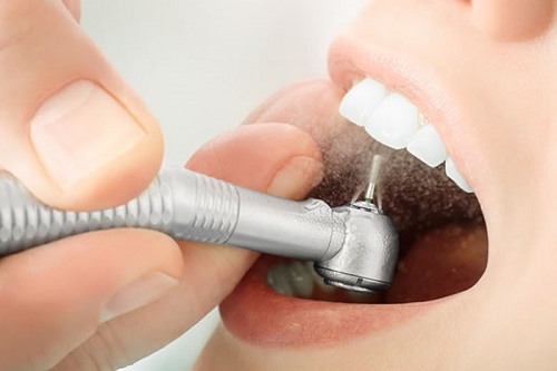 Răng sứ có bị xuống màu không? Cách khắc phục hiệu quả 2 Răng sứ có bị xuống màu không? Cách khắc phục hiệu quả 2
