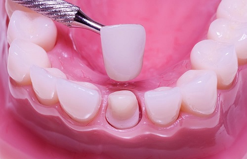 Lắp răng sứ có tháo ra được không bác sĩ? 1 Lắp răng sứ có tháo ra được không bác sĩ? 1