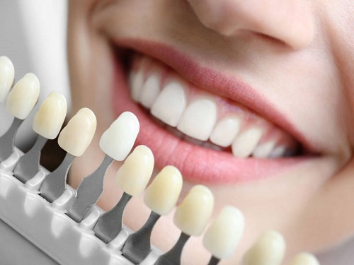 Lắp răng sứ có tháo ra được không bác sĩ? 3 Lắp răng sứ có tháo ra được không bác sĩ? 3