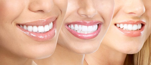 Lắp răng sứ có tháo ra được không bác sĩ? 4 Lắp răng sứ có tháo ra được không bác sĩ? 4