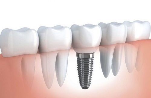 Trồng răng cấm hết bao nhiêu tiền hiện nay? 1 Trồng răng cấm hết bao nhiêu tiền hiện nay? 1