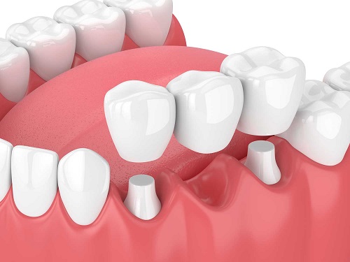 Trồng răng cấm hết bao nhiêu tiền hiện nay? 2 Trồng răng cấm hết bao nhiêu tiền hiện nay? 2