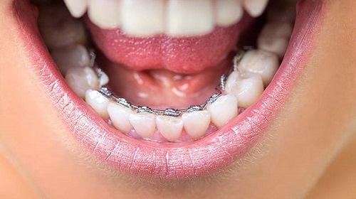 Trồng răng giả có niềng được không? Chuyên gia tư vấn 3 Trồng răng giả có niềng được không? Chuyên gia tư vấn 3