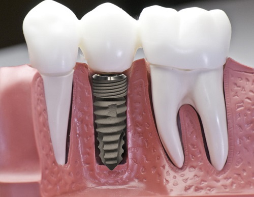Trồng răng hàm implant giá bao nhiêu tiền tại nha khoa? 1 Trồng răng hàm implant giá bao nhiêu tiền tại nha khoa? 1