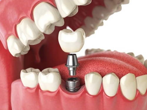 Trồng răng hàm implant giá bao nhiêu tiền tại nha khoa? 2 Trồng răng hàm implant giá bao nhiêu tiền tại nha khoa? 2
