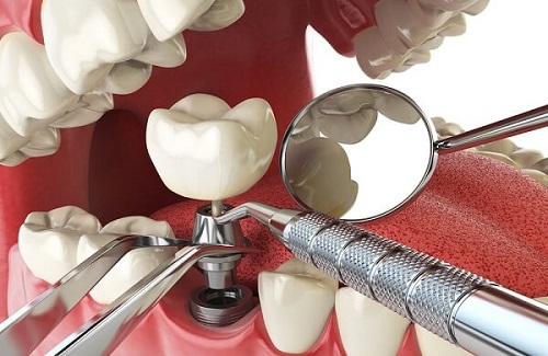 Trồng răng hàm implant giá bao nhiêu tiền tại nha khoa? 3 Trồng răng hàm implant giá bao nhiêu tiền tại nha khoa? 3