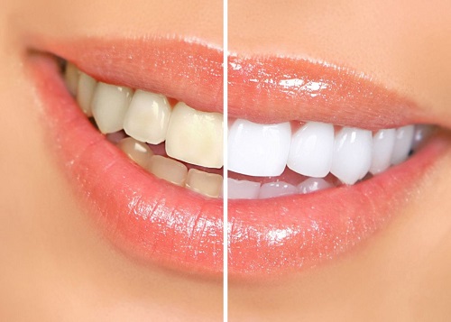 Trồng răng sứ bị đen chân răng - Nguyên nhân do đâu 1 Trồng răng sứ bị đen chân răng - Nguyên nhân do đâu 1
