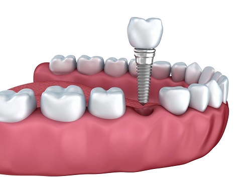 Trồng răng sứ bị nhức - Nguyên nhân và cách khắc phục 3 Trồng răng sứ bị nhức - Nguyên nhân và cách khắc phục 3