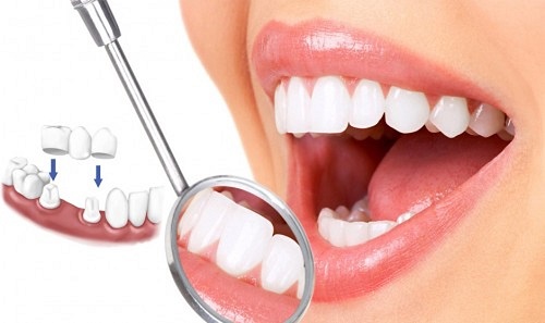 Trồng răng sứ có ảnh hưởng gì không? Tìm hiểu 1 Trồng răng sứ có ảnh hưởng gì không? Tìm hiểu 1