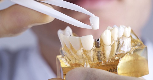 Trồng răng sứ có lâu không? Quy trình thực tế cho bạn 3 Trồng răng sứ có lâu không? Quy trình thực tế cho bạn 3