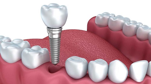 Tham khảo nội dung: Trồng răng sứ có tháo ra được không? 3 Tham khảo nội dung: Trồng răng sứ có tháo ra được không? 3