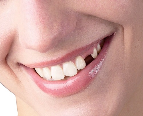 Trồng răng sứ có tốt không? Ưu điểm của dịch vụ này 1 Trồng răng sứ có tốt không? Ưu điểm của dịch vụ này 1