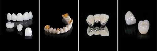 Trồng răng sứ dùng được bao lâu? Dựa vào yếu tố nào 3 Trồng răng sứ dùng được bao lâu? Dựa vào yếu tố nào 3