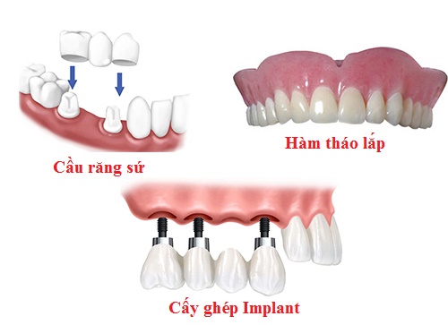 Trồng răng bao nhiêu tiền 1 cái? Có tùy thuộc trường hợp nặng nhẹ? 2 Trồng răng bao nhiêu tiền 1 cái? Có tùy thuộc trường hợp nặng nhẹ? 2
