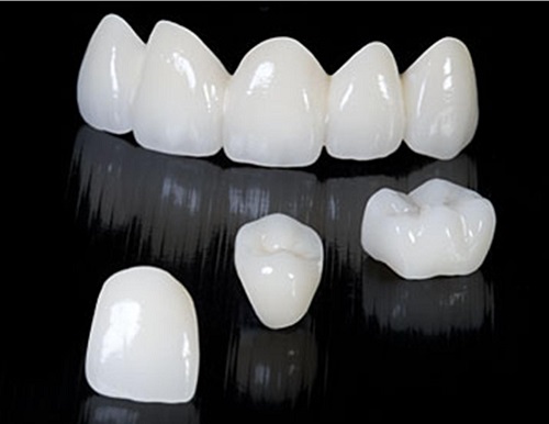 Trồng răng bao nhiêu tiền 1 cái? Có tùy thuộc trường hợp nặng nhẹ? 3 Trồng răng bao nhiêu tiền 1 cái? Có tùy thuộc trường hợp nặng nhẹ? 3