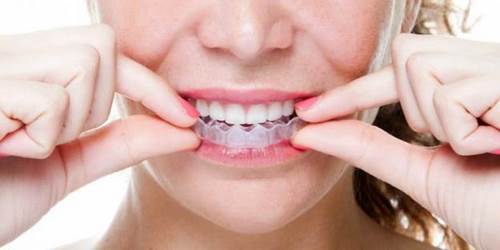 Tẩy trắng răng bằng máng bao nhiêu tiền? 1 Tẩy trắng răng bằng máng bao nhiêu tiền? 1