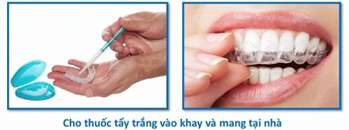 Tẩy trắng răng bằng máng bao nhiêu tiền? 2 Tẩy trắng răng bằng máng bao nhiêu tiền? 2