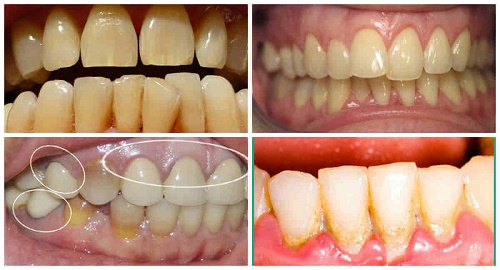 Tẩy trắng răng bằng máng có tốt không? Tìm hiểu chuyên sâu 1 Tẩy trắng răng bằng máng có tốt không? Tìm hiểu chuyên sâu 1
