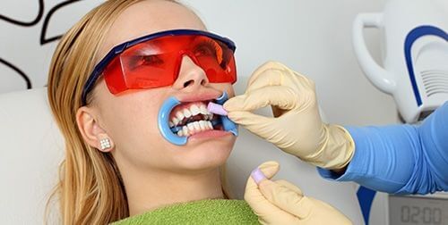 Tẩy trắng răng bằng máng có tốt không? Tìm hiểu chuyên sâu 3 Tẩy trắng răng bằng máng có tốt không? Tìm hiểu chuyên sâu 3