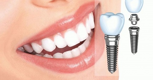 Thời gian cấy ghép răng implant trong bao lâu? 4
