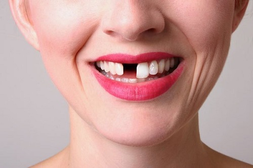 Trồng răng bị rụng - Phục hình hiệu quả tại nha khoa 1