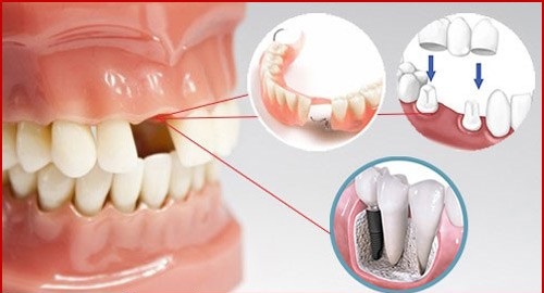 Trồng răng bị rụng - Phục hình hiệu quả tại nha khoa 2