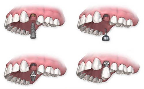 Trồng răng bị rụng - Phục hình hiệu quả tại nha khoa 3