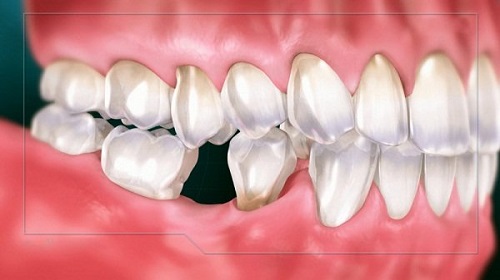 Trồng răng sứ có đau không? Chuyên gia giải đáp 1 Trồng răng sứ có đau không? Chuyên gia giải đáp 1