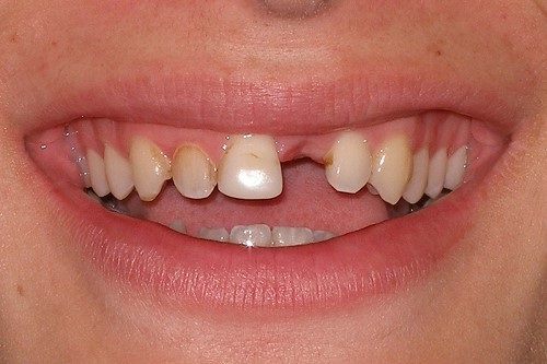 Trồng răng nên ăn gì để duy trì kết quả lâu dài? 1