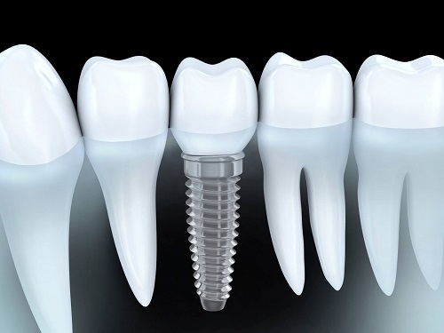 Trồng răng nên ăn gì để duy trì kết quả lâu dài? 2