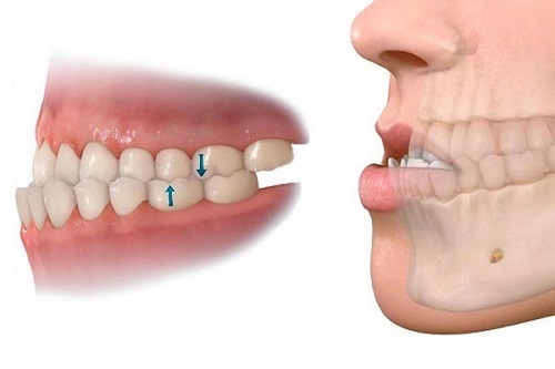 Phẫu thuật cắt xương hàm có nguy hiểm không? Nha khoa giải đáp 1 Phẫu thuật cắt xương hàm có nguy hiểm không? Nha khoa giải đáp 1