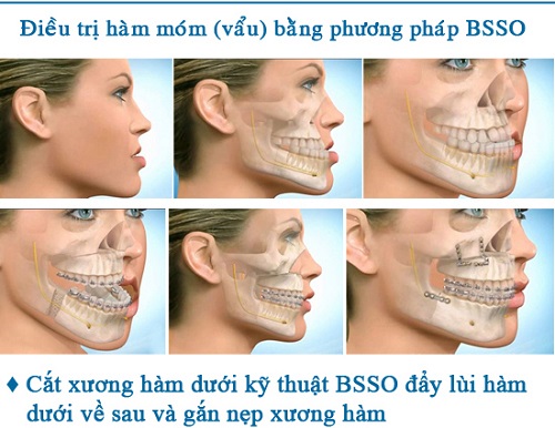 Phẫu thuật cắt xương hàm có nguy hiểm không? Nha khoa giải đáp 2 Phẫu thuật cắt xương hàm có nguy hiểm không? Nha khoa giải đáp 2